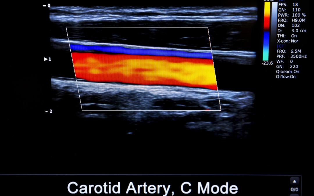 USG Doppler tętnic kończyn dolnych